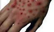 Bệnh sốt xuất huyết do virut Ebola, Marburg và cách phòng, chống
